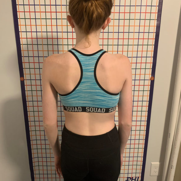 13 year old scoliosis treatment using Schroth Method