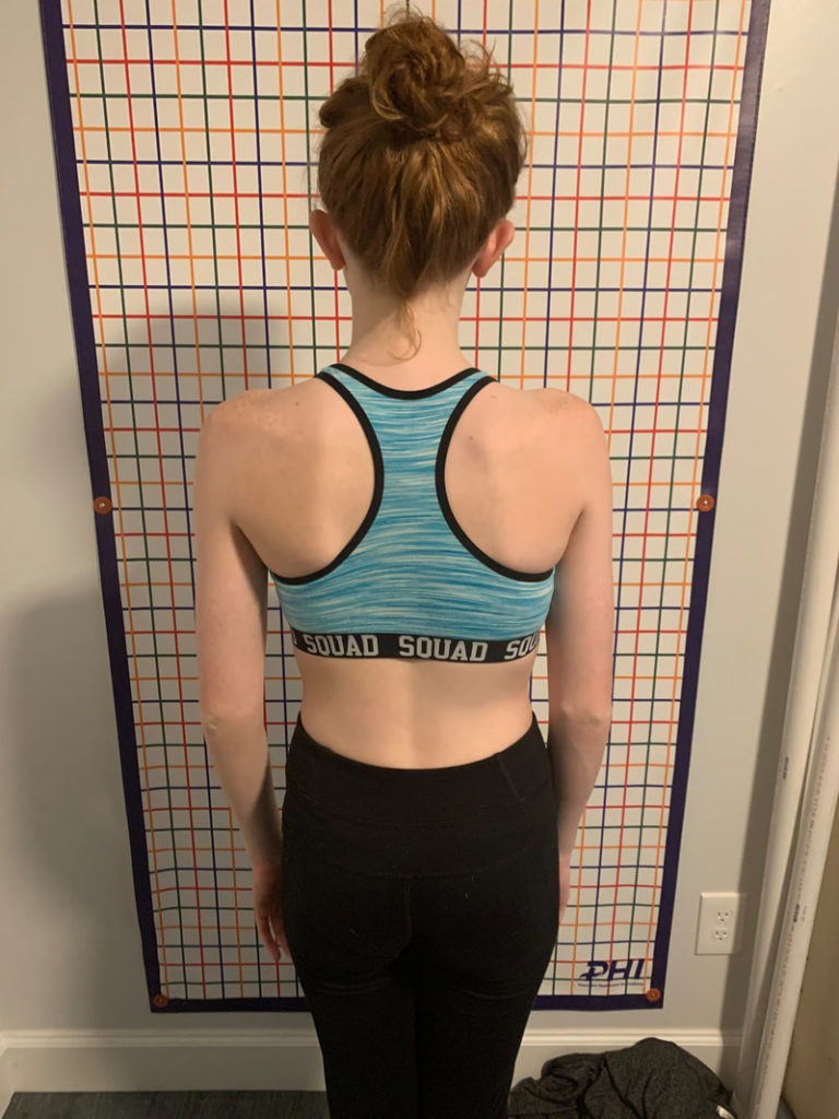 13 year old scoliosis treatment using Schroth Method