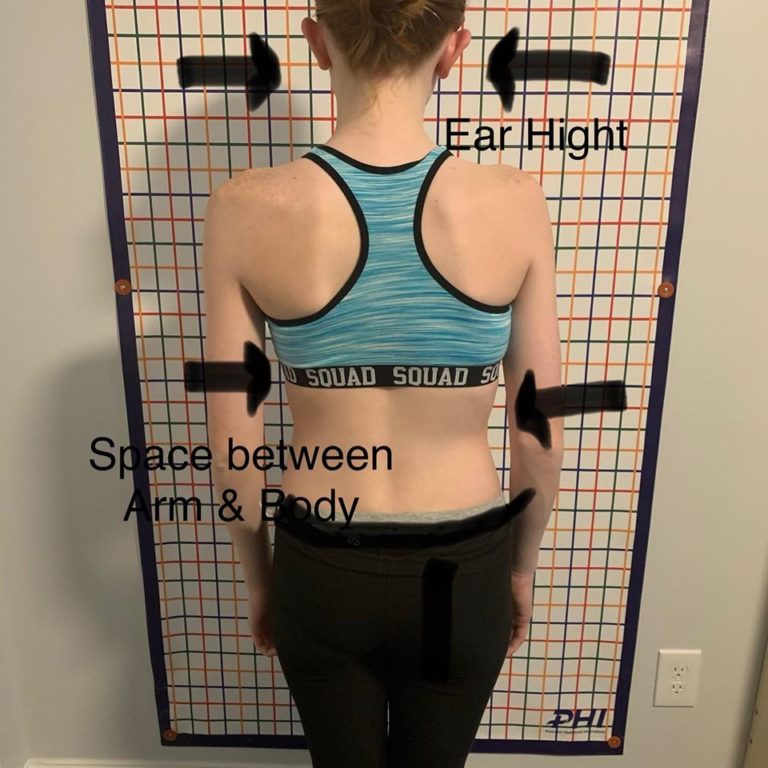 identifying ear height scoliosis