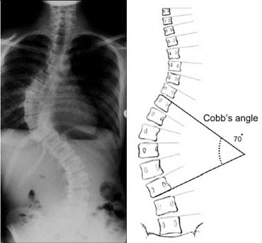 Cobb's angle x-ray measuring at 70 degrees