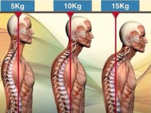 forward head posture