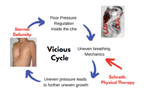 coke can diagram of pectus excavatum