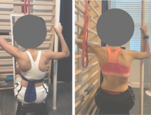 schroth method before and after