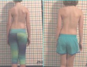 scoliosis treatment before and after