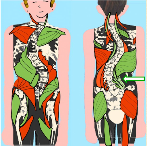 The green muscle is SHORT The red muscle is LONG In the right low back (lumbar concave) the muscle is shortened