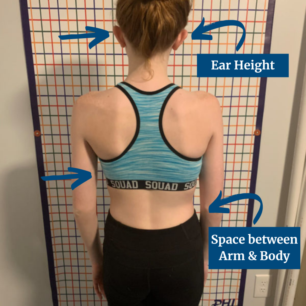 Understanding Types of Scoliosis | ScoliosisPTJax